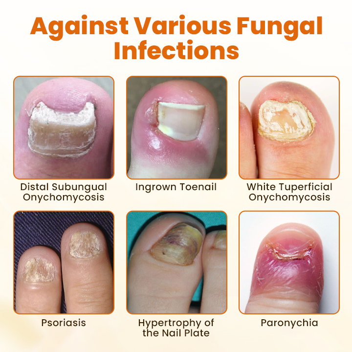 Timilk® FungiBee Fortschrittliches Nagelreparatur-Spray⚕️
