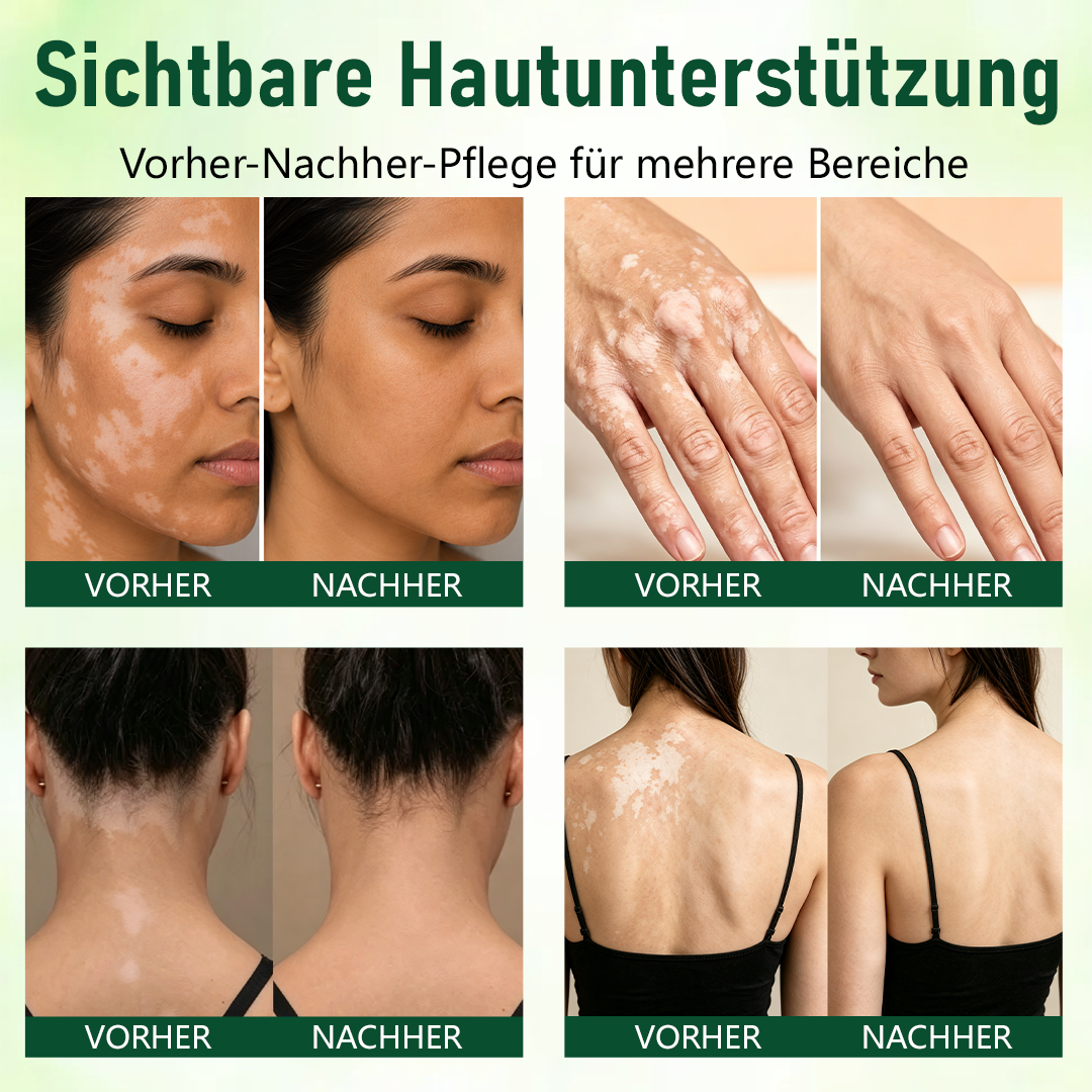 Ceoerty® Kräuter-Vitiligo-Creme