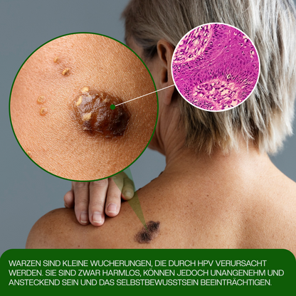 Timilk® ClinixClear Warzenentfernungs-Pflaster