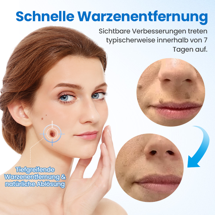 Timilk® TagGone Warzenentfernungscreme