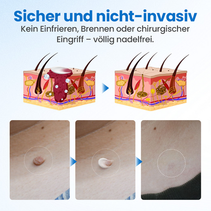 Timilk® TagGone Warzenentfernungscreme