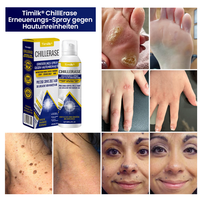 Timilk® ChillErase Erneuerungs-Spray gegen Hautunreinheiten ⚕️